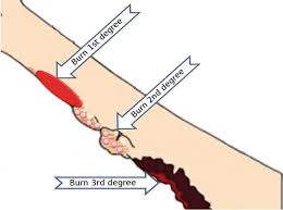 A dry slough, crust, or scab, which separates from the healthy part of the body, as that produced by a burn, or the application of caustics. Burn Etiology And Pathogenesis Intechopen