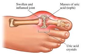Image result for gout