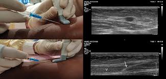 Image result for IV Access