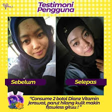 Dian'z vitamin c & e plus premium 2019 merupakan supplimen atau makanan tambahan yang telah dilulusakan oleh dianz mask & moist cara guna, feedback, testimoni, review, preview pengguna. Facebook