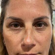 Say goodbye to tired eyes and hello to a refreshed, youthful glow! ✨ Our  talented aesthetician @fullspecialist_farrah worked her magic with an  under-eye chemical peel, transforming dull, tired skin into bright,  rejuvenated