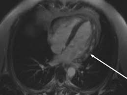 Pathowiki bietet eine freie öffentliche plattform für texte, bilder, virtuelle präparate und links zu stichworten aus allen themengebieten der pathologie. 15 Atypische Angina Pectoris Arztekammer Nordrhein
