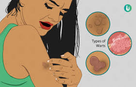 Image result for human papillomavirus symptoms