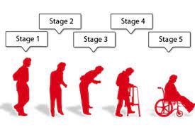 Stage 3 is the middle stage in parkinson's, and it marks a major turning point in the progression of the disease. Stages Of Parkinson S Disease Plexus