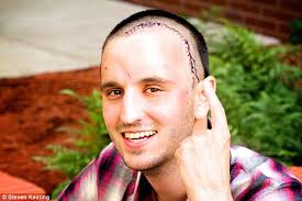 MIT student Steven Keating cuts up and studies his OWN brain tumor