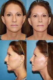 Pin On Rhinoplasty