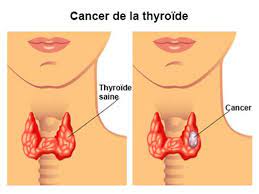 We did not find results for: Cancer De La Thyroide Symptomes Traitement Definition Docteurclic Com
