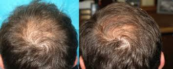 As a pioneer of this treatment (since. Acell Prp Case Studies Trichostem Hair Regeneration New York