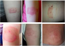 Image result for dermatitis contacta children