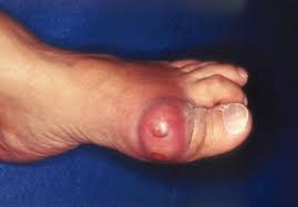 Image result for gout