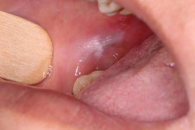 White Patches in the Mouth: Causes & When to See a Specialist