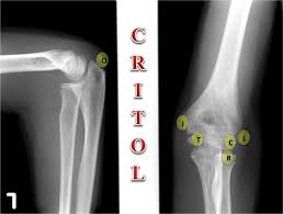 Related searches for lateral medial epicondyle: The Elbow