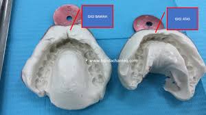 Pendakap gigi (braces) jenis ini adalah yang paling popular dan biasanya apa yang kita bayangkan. Luqman Kongsi Pengalaman Pakai Braces Part 2