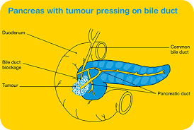 Symptoms might not appear until the cancer affects other organs. Advanced Panreatic Cancer Treatment Cancer Council Victoria