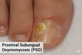 Image result for onychomycosis