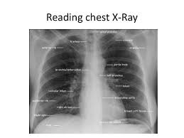 Pin On Understanding Breast Cancer