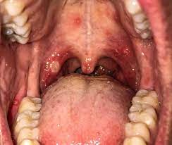 Why Does The Roof Of My Mouth Hurt Causes Systems Explained Cards Dental