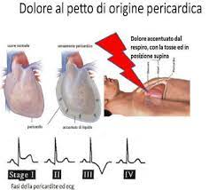 La pericardite acuta esordisce quasi sempre con un dolore toracico. Il Dolore Toracico Di Origine Pericardica
