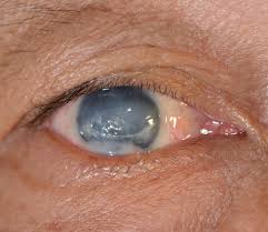 The nottingham family glaucoma screening study / br. Glaucoma Eye Specialists Sydney Eye Specialists Ophthalmologists