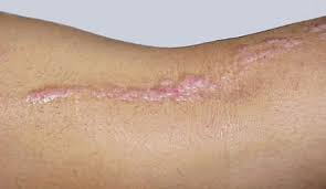 Image result for Linear Dermatitis