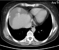 peritoneal mesothelioma is a rare cancer of the abdominal lining with about 600 cases per year in the united states. Ct Differentiation Of Malignant Peritoneal Mesothelioma And Tuberculous Peritonitis Semantic Scholar