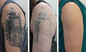 A tattoo removal laser can offer single or multiple functions. Laser Tattoo Benign Pigmented Blemish Removal Level 4 Online Laser Training
