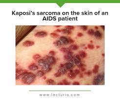 Learn more about the different types, causes, symptoms, diagnosis, treatment, and prevention of kaposi's sarcoma. Kaposi Sarcoma Is A Rare Tumor That Has Lecturio Medical Facebook
