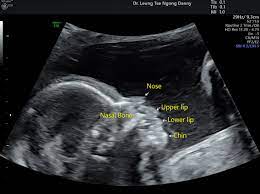 Absence Of Fetal Nasal Bone Hypoplastic Nasal Bone Hkog Info