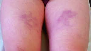 Nếu không được điều trị và can thiệp tích cực, lupus có thể đe dọa tính mạng. Pannikulitis Hauterkrankungen Msd Manual Ausgabe Fur Patienten