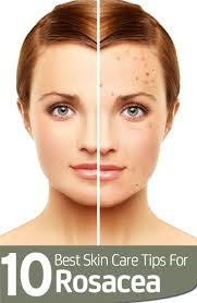 Home Remedies To Get Rid Of Redness On The Face Rosacea Skin Care Rosacea Redness On Face