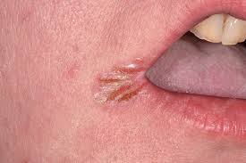 Image result for Angular Stomatitis