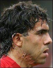 Carlos tevez may return to the manchester city lineup. How Carlos Tevez Got His Neck Scars Footyblog Net