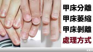 甲床分離 萎縮剝離 產生的原因與處理方式 nails