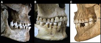 However, this is not always. Wisdom Teeth Pictures Symptoms Surgery Pain Relief Ask The Dentist