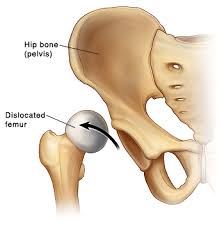 Maybe you would like to learn more about one of these? When Your Child Has Developmental Dysplasia Of The Hip