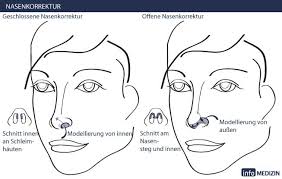 Einige leute berichten von schmerzen in der nase, während andere von schmerzen auf dem nasenrücken berichten. Nasenkorrektur Ohne Op Mit Hyaluronsaure Info Medizin