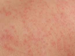 How To Get Rid Of Cholinergic Urticaria Rash Treatment Heat Rash Treatment Heat Rash