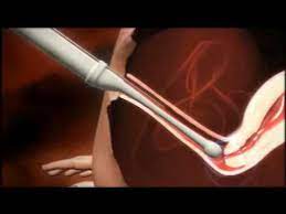 The national infertility association is a 501(c)3, national patient advocacy organization. 3d Animation Of How Ivf Works Youtube