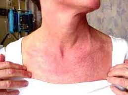 Image result for Polymyositis