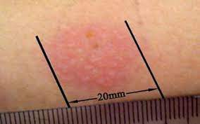 We did not find results for: Malaysian Family Physicians Role Of Mantoux In The Diagnosis Of Tuberculosis