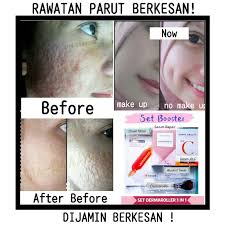 Saya ingin bertanya kepada dok, saya mempunyai masalah dengan jerawat dan komedo di wajah saya yang tidak sembuh. Buy Microneedle Parut Jerawat Set Dermaroller High Quality Parut Berlubang Serum Parut Pori Terbuka Deep Scar Acne Serum Sc Seetracker Malaysia