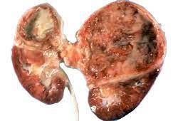 Essas bactérias estão presentes normalmente no intestino, mas devido a alguma condição podem proliferar e atingir os rins. Pielonefrite Aguda Sintomas Diagnostico E Tratamento Bmj Best Practice
