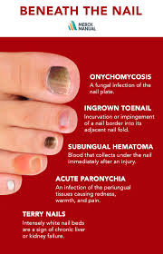 Most of the time, paronychia is not serious and can be treated at home. Learn More About What S Going On Beneath The Nail Ingrown Toe Nail Nail Disorders Nail Health