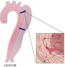 56829 12 3 4 5 6 7 8 9 10. è‡´å'½æ€§çš„èƒ¸ç—›åŠä¸»å‹•è„ˆæ€¥ç—‡ åˆæŽ¢æ€¥æ€§ä¸»å‹•è„ˆå‰é›¢ä½œè€… è‡ºå¤§é†«é™¢å¤–ç§'éƒ¨å¿ƒè¡€ç®¡å¤–ç§'å³æ¯…æš‰ä¸»æ²»é†«å¸«å°ˆé¡Œå ±å°Ž2017å¹´11æœˆè‡ºå¤§é†«é™¢å¥åº·é›»å­å ±