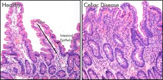 Celiac Disease Article