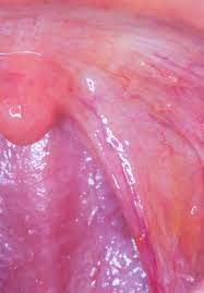Listening for any adventitious (added). Local Metastasis In Head And Neck Cancer An Overview Intechopen