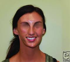 Scapular Free Flap for Soft Tissue Augmentation in Progressive Hemifacial  Atrophy