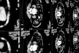 Quando necessário o tratamento é cirúrgico. Microcirurgia Para Clipagem De Aneurisma Cerebral Araujo E Fazzito Neurocirurgia E Neurologia Em Sao Paulo Araujo E Fazzito Neurocirurgia E Neurologia Em Sao Paulo