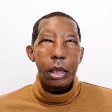 Thank you @time for sharing my story!!! 🔗 in bio Repost from @time •  Robert Chelsea turned down the first #face he was offered. It could have  taken him off the transplant