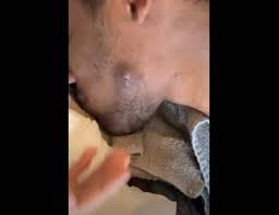 Even a dead skin can clog the hair follicle leading to ingrown pubic hairs as the hair is forced to grow under the skin. Ingrown Pubic Hair Cyst Archives New Pimple Popping Videos